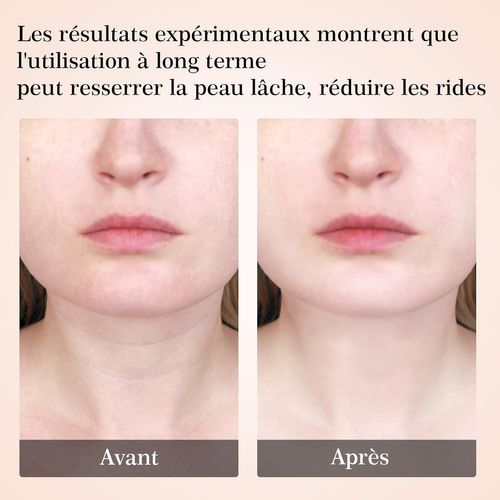 Noir Appareil Anti Rides Visage,appareil De Beauté, 145－115－60mm.soins De La Peau Disposit